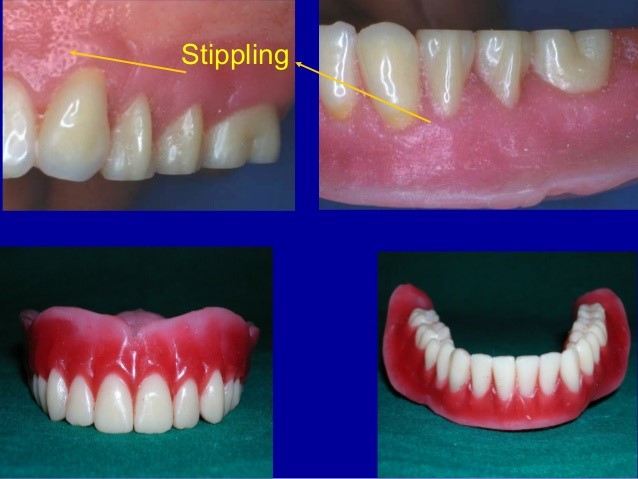 Partial 
      Dentures Before And After Northborough MA 1532